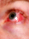 Eye
