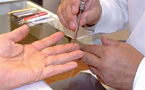 korean hand acupuncture demonstration