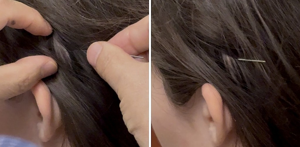 Dual image of needle placements in scalp acupuncture
