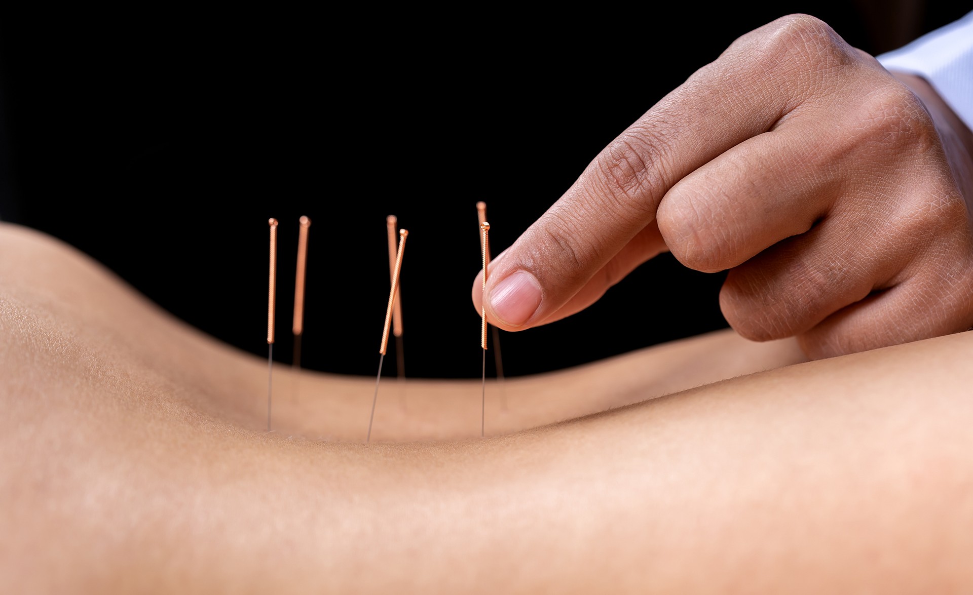 Acupuncture needling demonstrated on patient