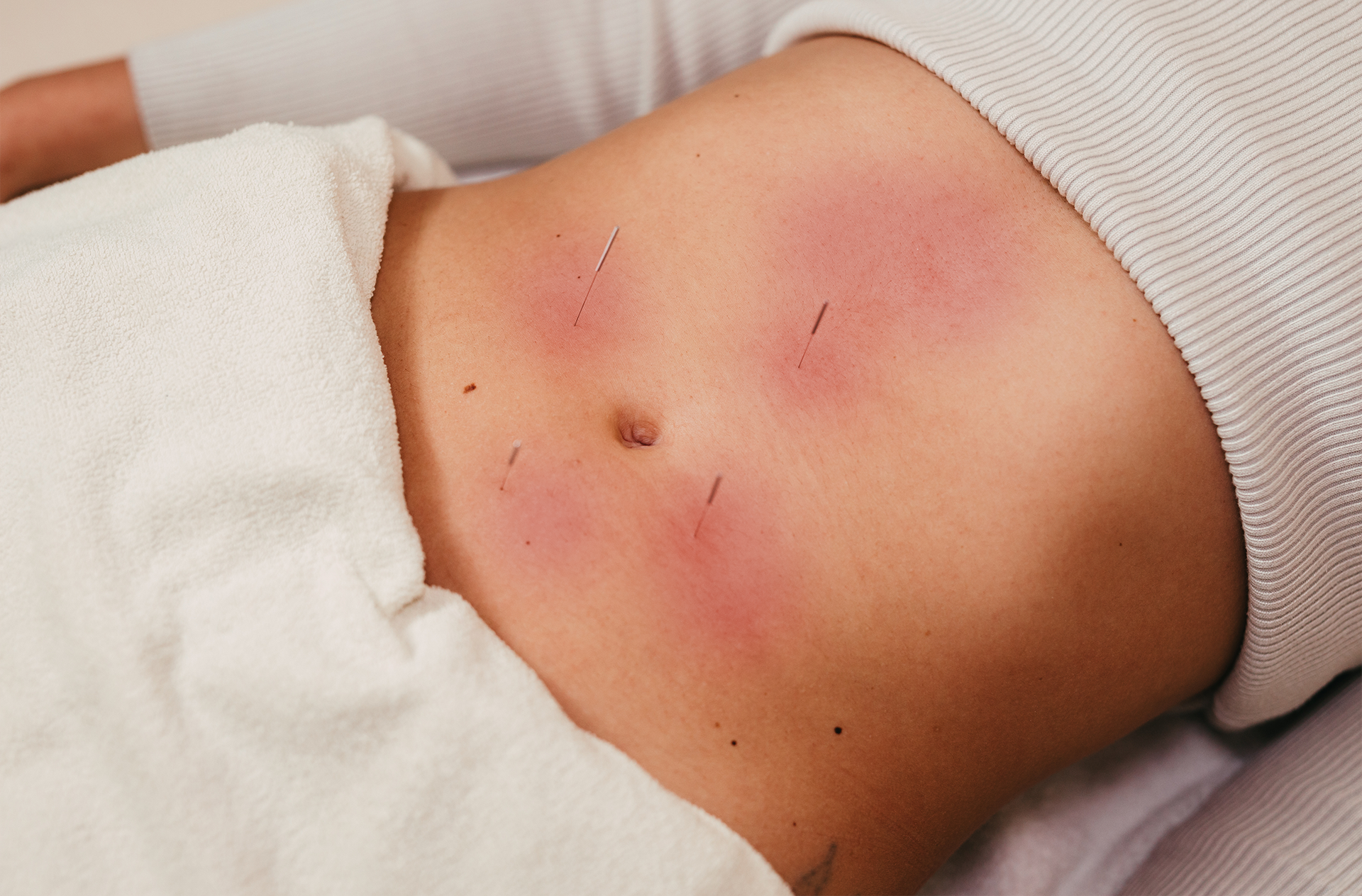 Female acupuncture patient with reddened skin