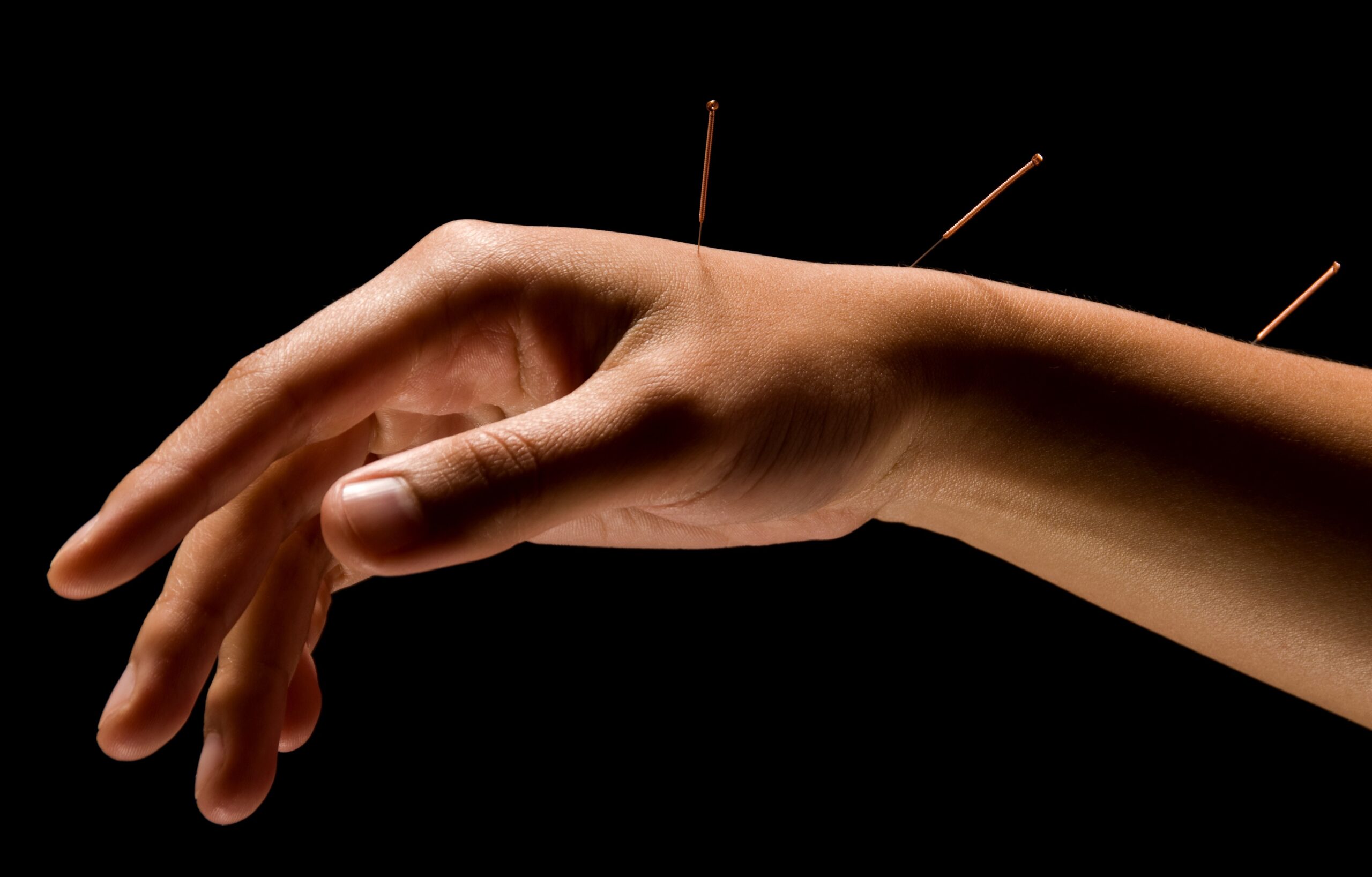 Adult patient's hand receiving acupuncture treatment