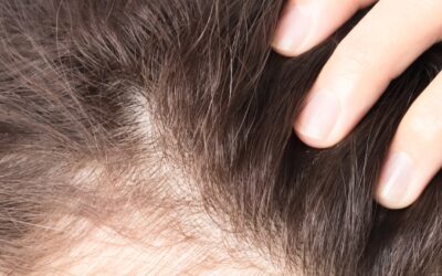 Hair Loss or Thinning Hair