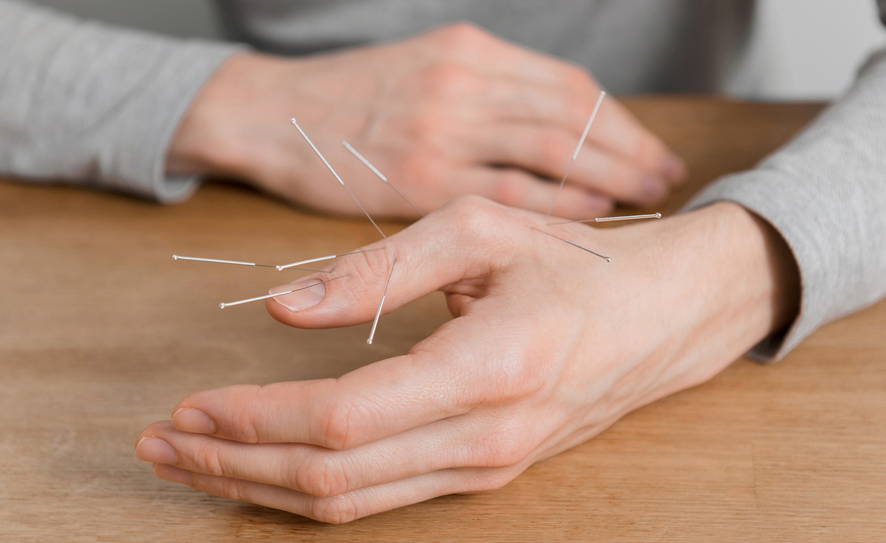 Hand of acupuncture patient with therapeutic needles