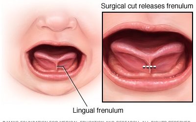Health Problems Caused by Tongue Tie in Adults