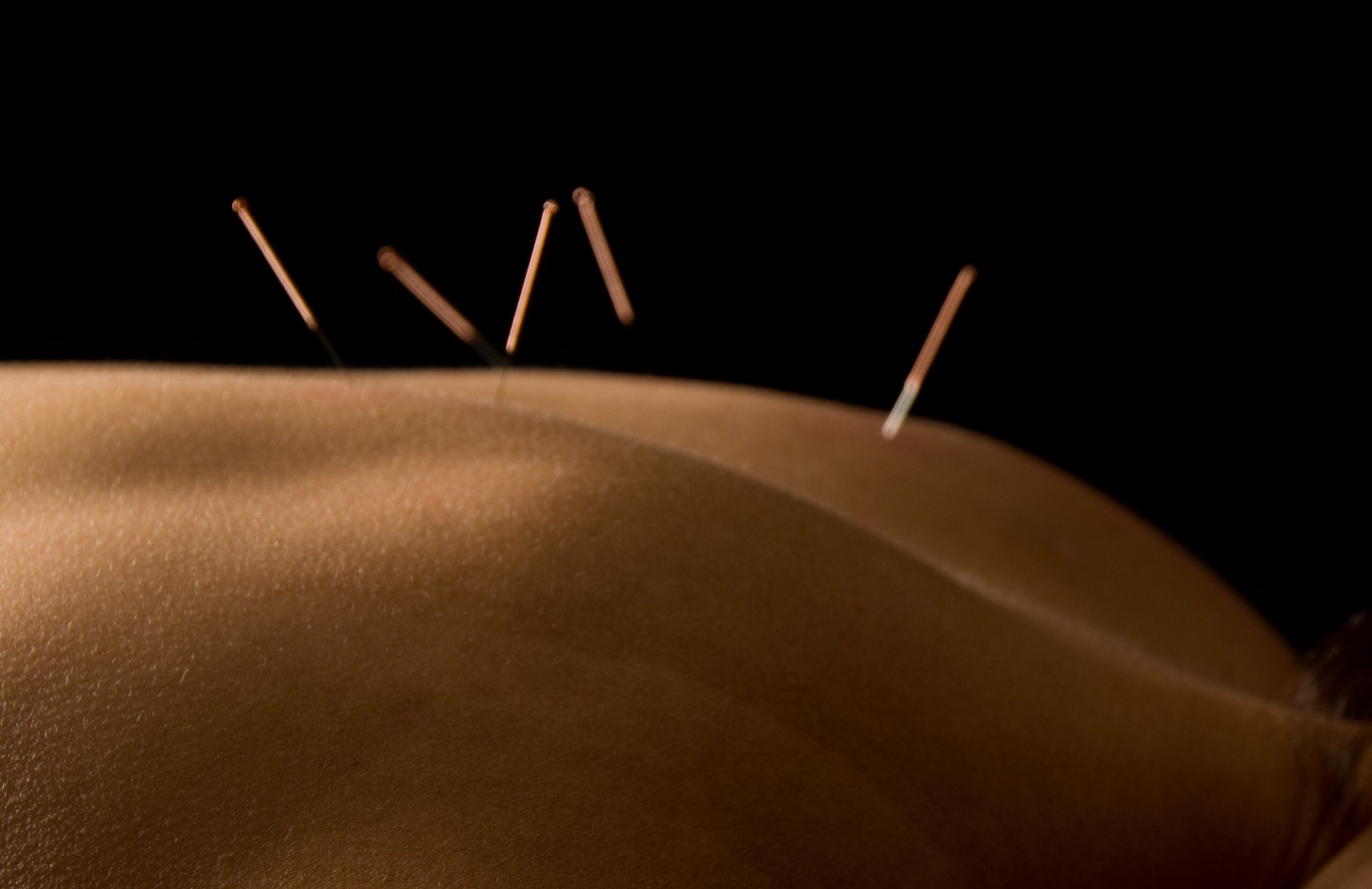 closeup of acupuncture needles along patient's spine