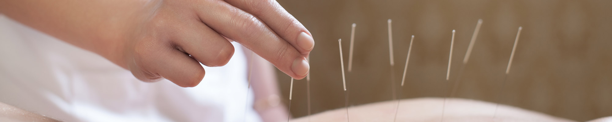 acupuncturist placing needles in patients back