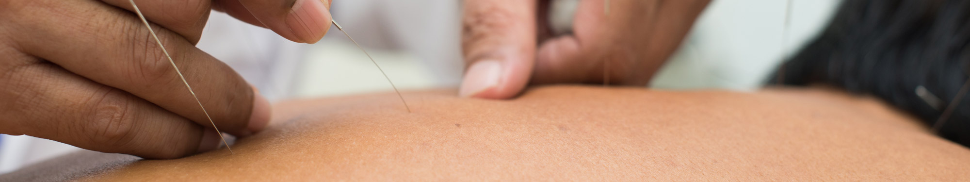 doctor performing acupuncture on patient's back